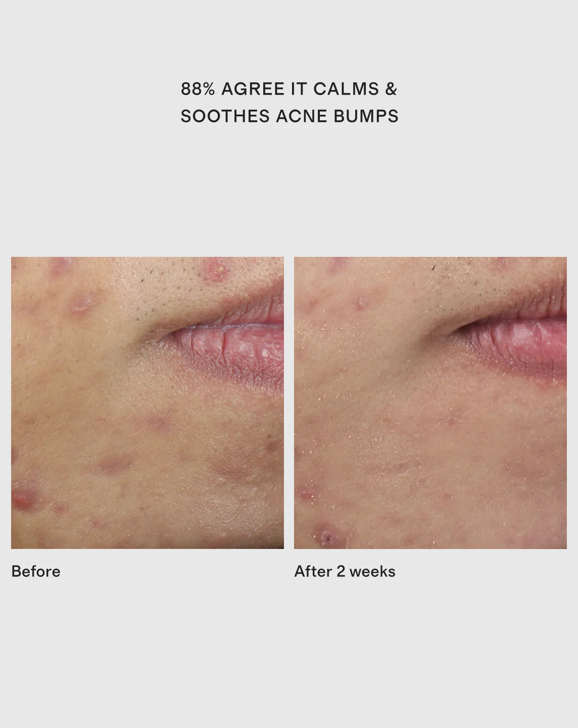 Deep Relief Acne Serum by Murad - One Size / No Color